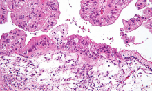 Micrograph of a mucinous ovarian tumor (Photo National Institutes of Health) Micrograph of a mucinous ovarian tumor (Photo National Institutes of Health)